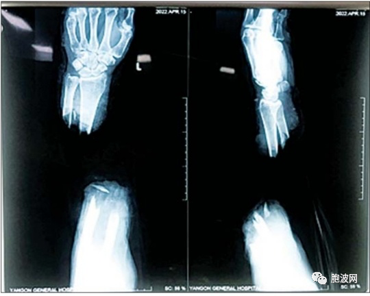 仰光人民医院医学新成就：断肢再植手术成功！