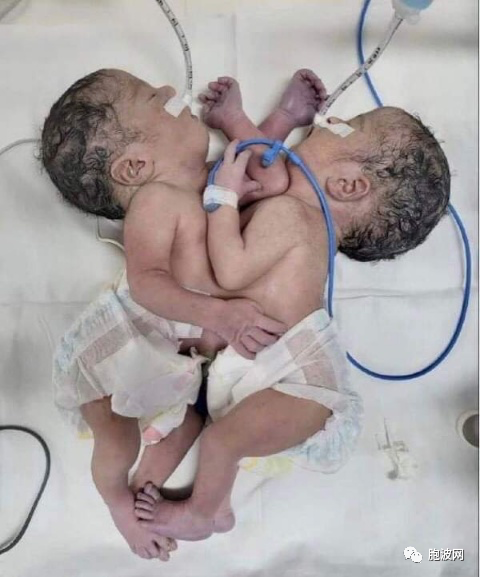 曼德勒中央妇女医院帮助一母亲成功产下连体双胞胎