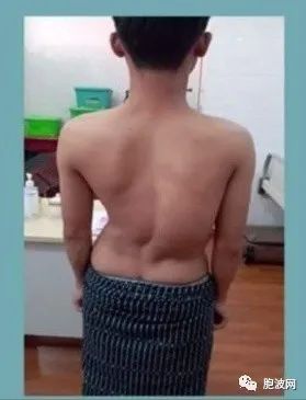 缅甸医学界成就：18年内成功完成200余例先天性脊椎畸形矫正手术