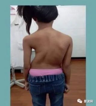 缅甸医学界成就：18年内成功完成200余例先天性脊椎畸形矫正手术